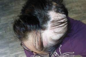 kreisrunder Haarausfall