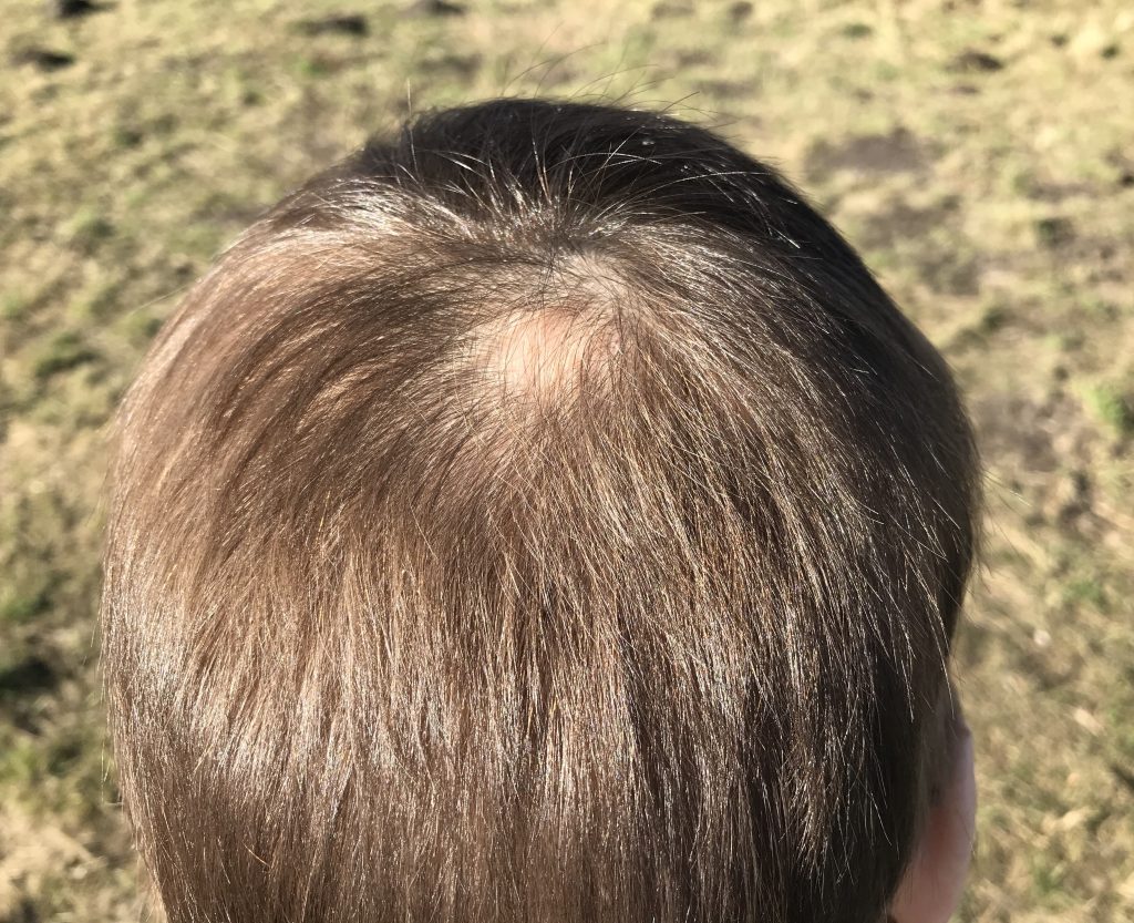 Alopecia kreisrunder Haarausfall