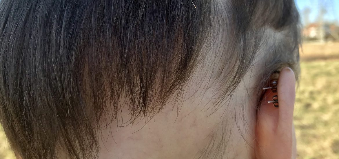 Alopecia wachsen meine Haare wieder?